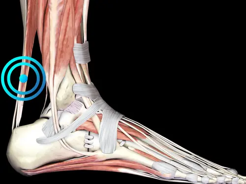 Tendinitis de Aquiles