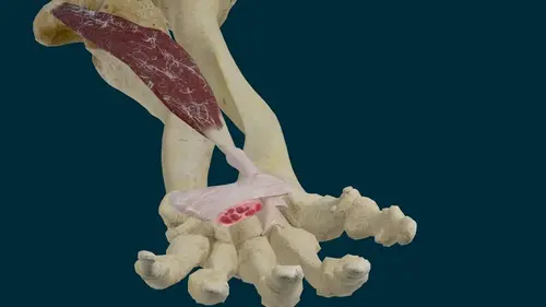 Tendinitis del músculo flexor del carpo