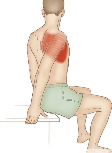 Tendinitis del serrato anterior