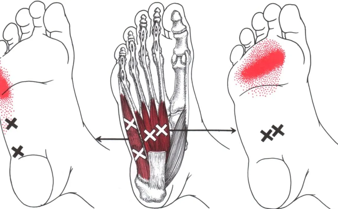 Tendinitis del abductor del dedo meñique