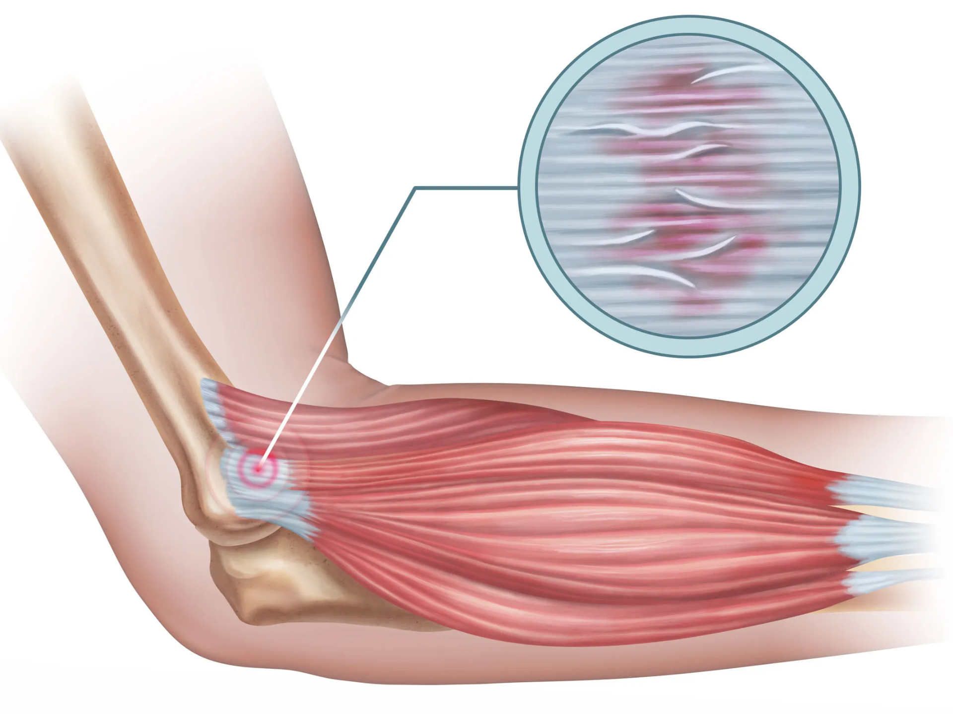 ¿Qué es la tendinitis del extensor común?