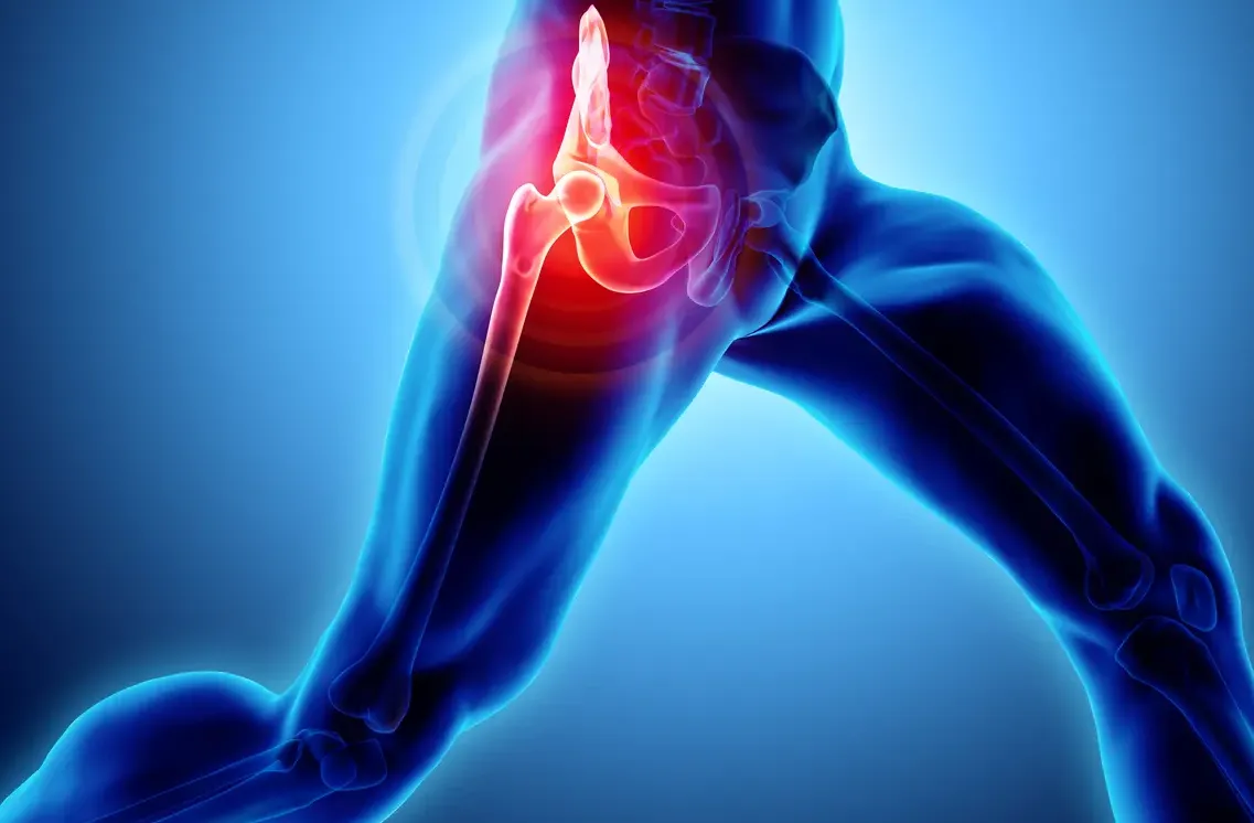 ¿Qué es la tendinitis del glúteo medio?