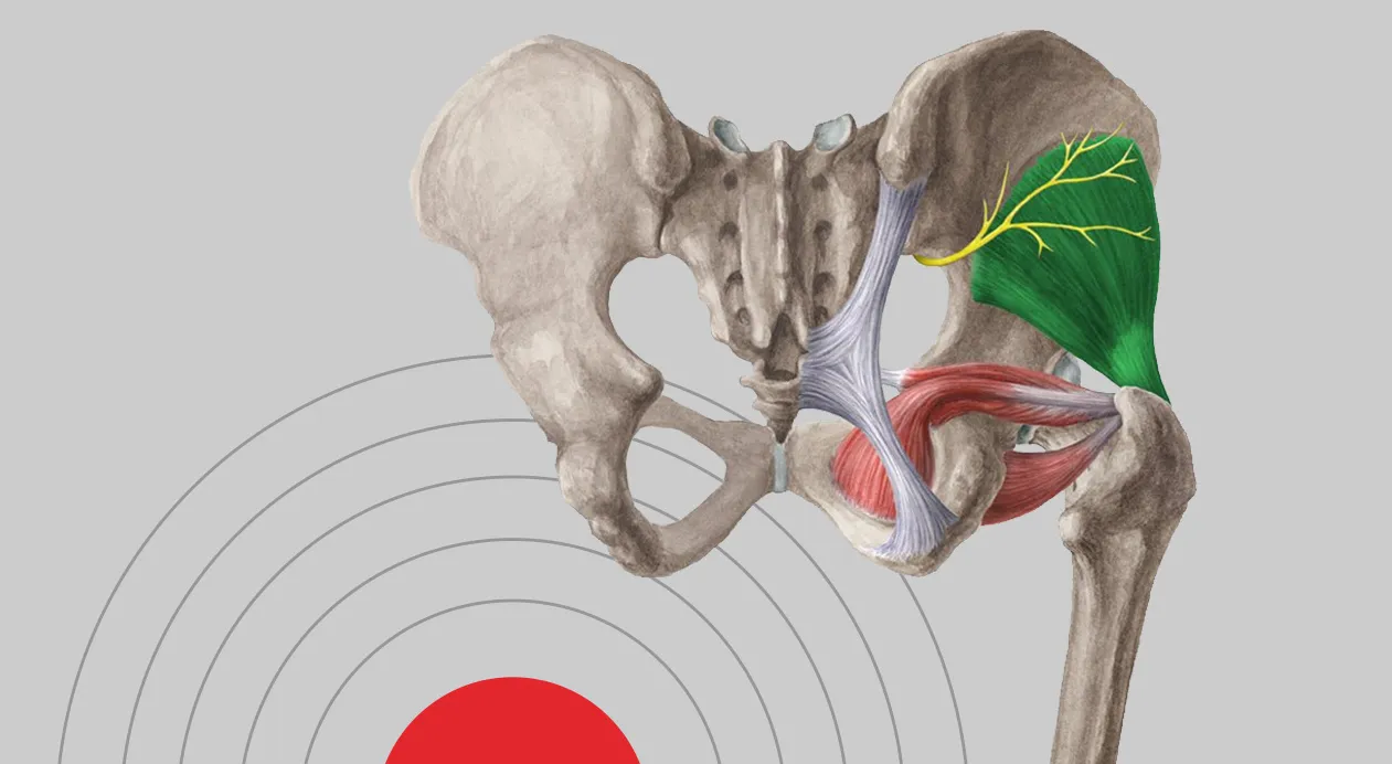 Síntomas comunes de la tendinitis del glúteo medio