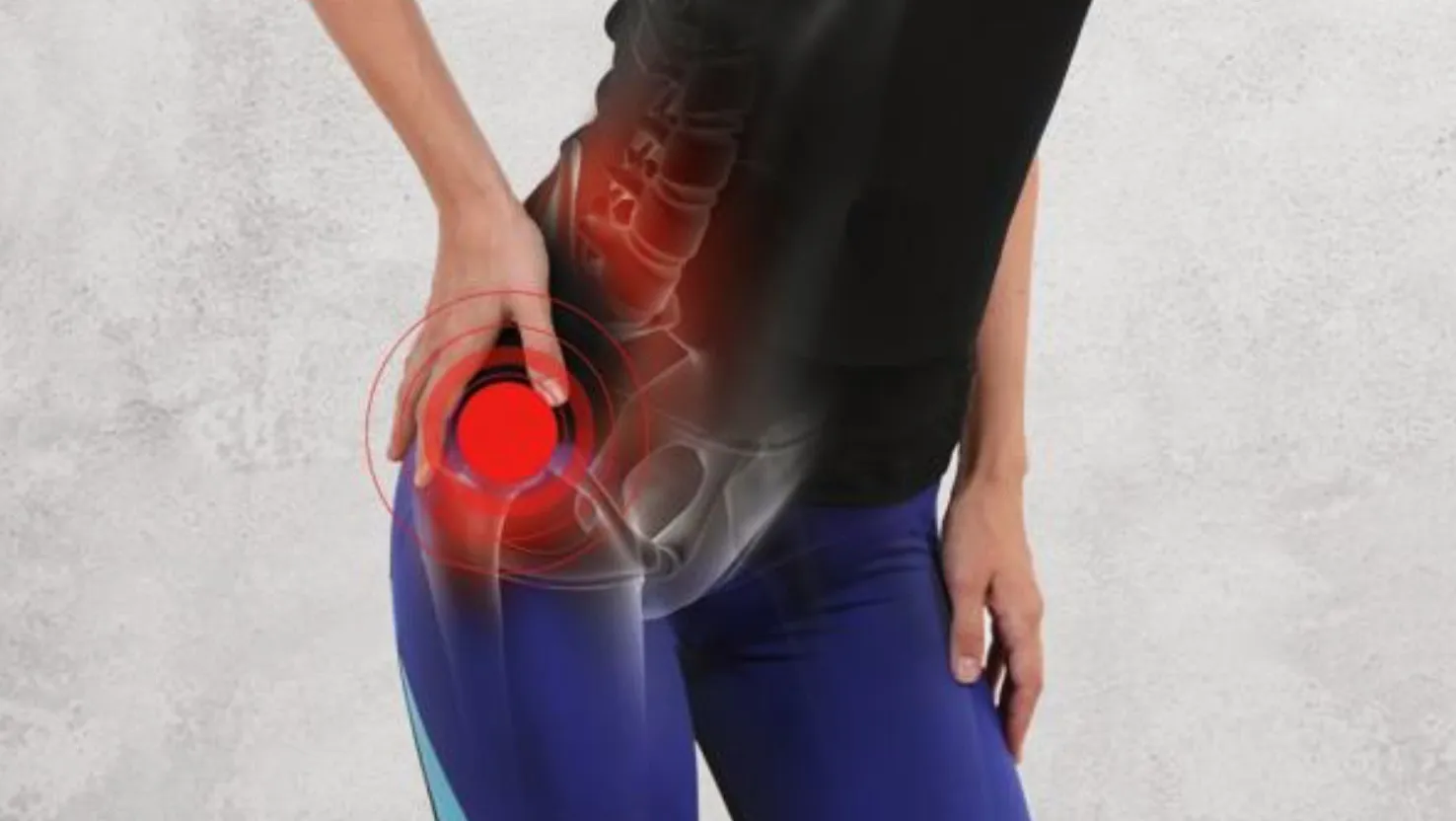 Tratamiento para la tendinitis del glúteo medio