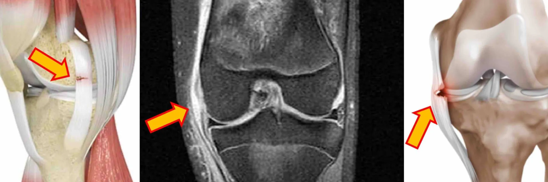 Tendinitis del ligamento colateral medial