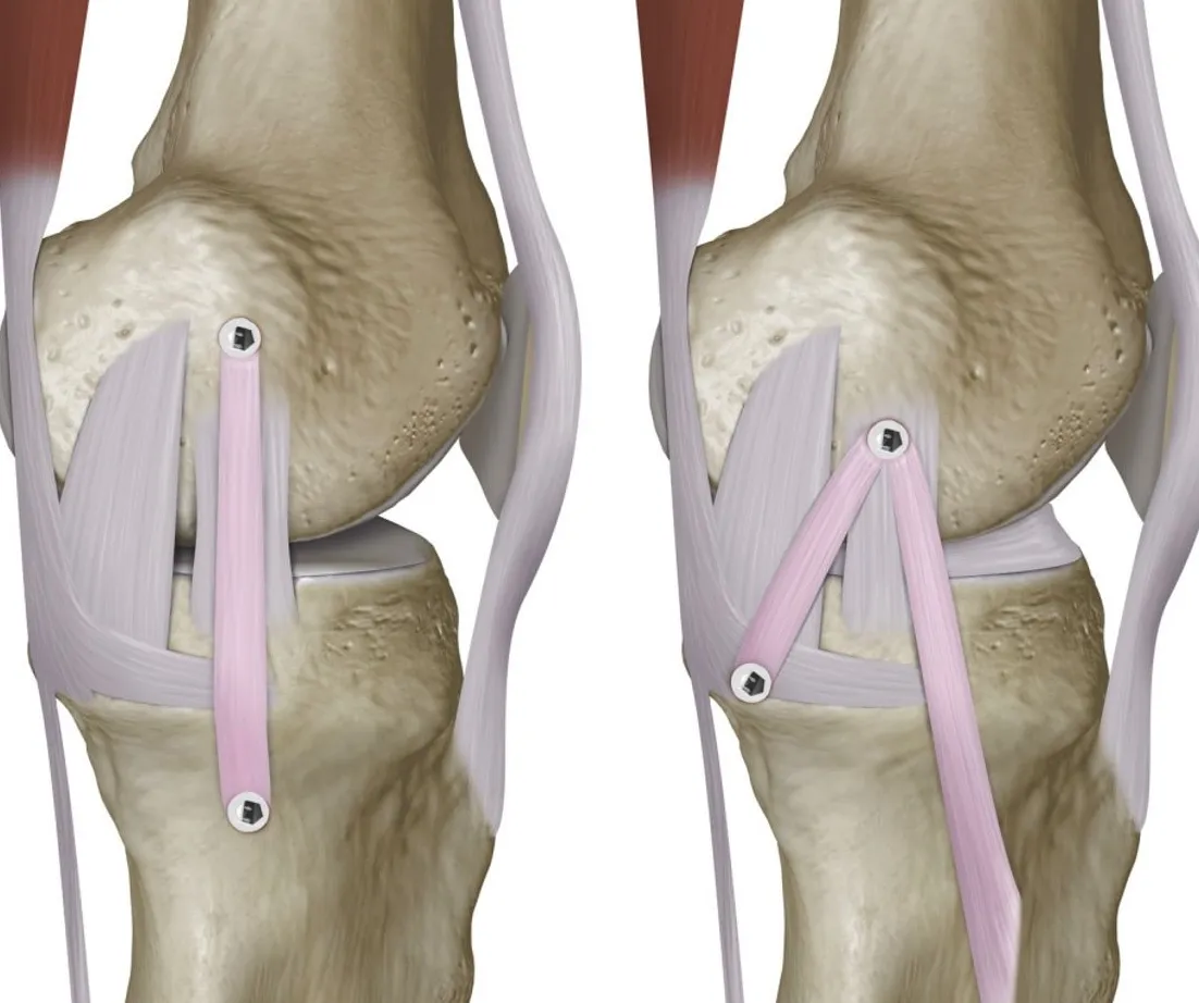 ¿Qué es la tendinitis del ligamento colateral medial?