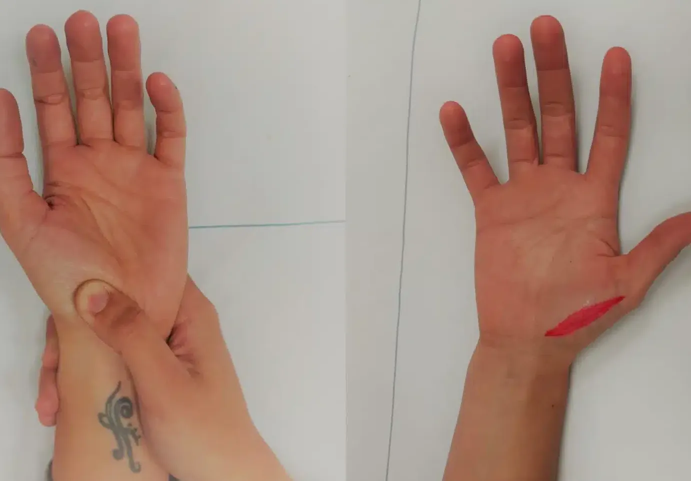 ¿Cómo identificar la tendinitis del oponente del pulgar?