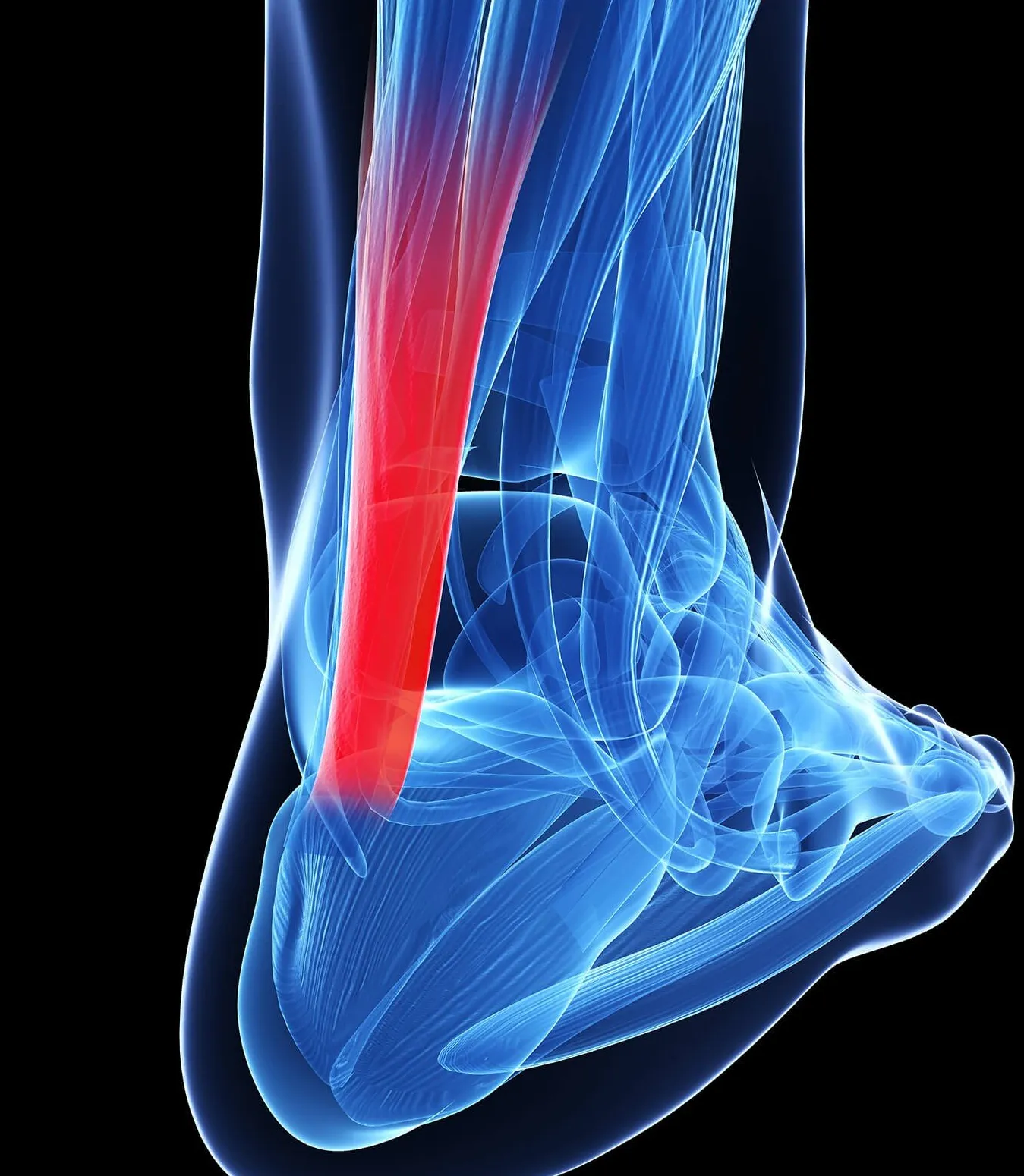 Tendinitis del peroneo