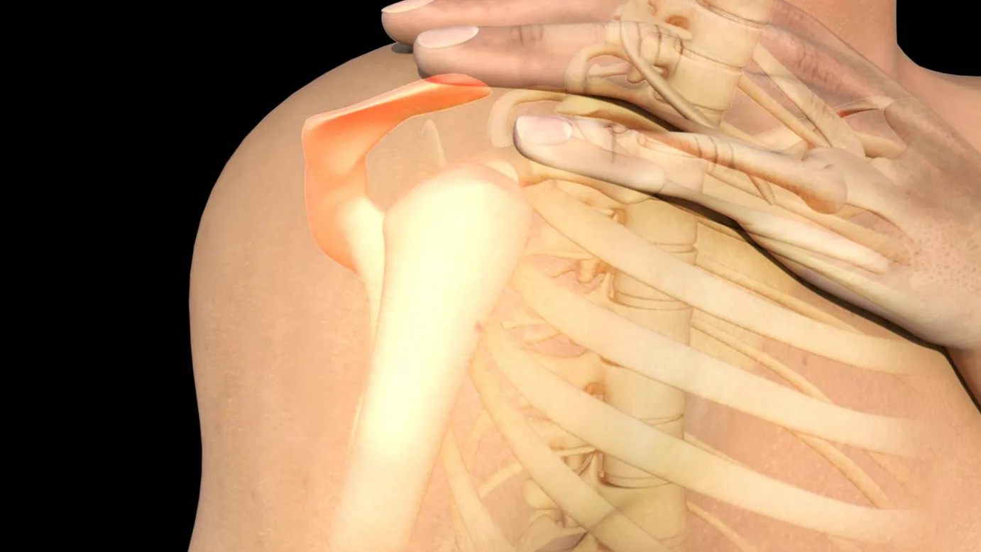 ¿Qué es la tendinitis del supraespinoso?