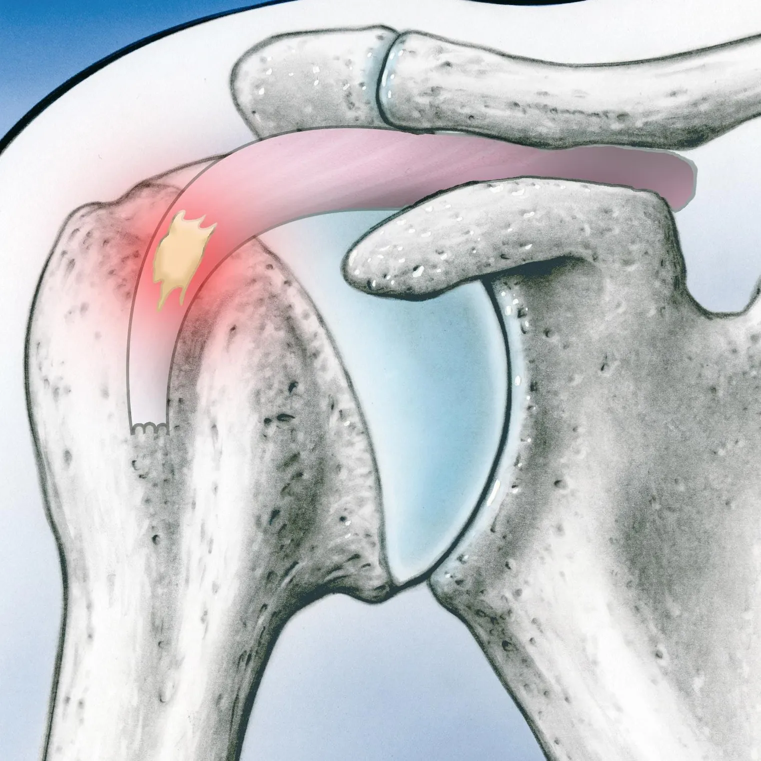 Tratamiento de la tendinitis del supraespinoso