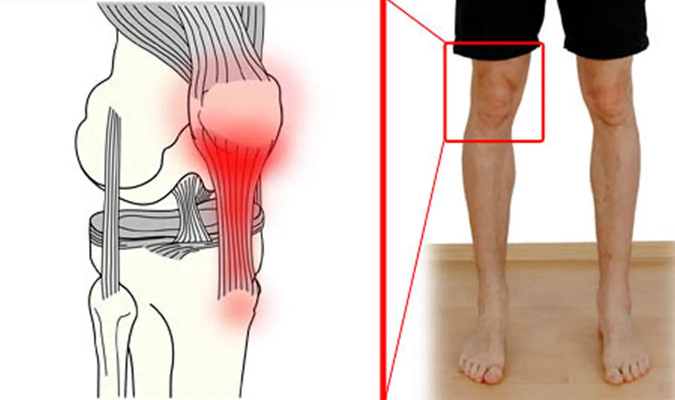 Tendinitis del tendón rotuliano